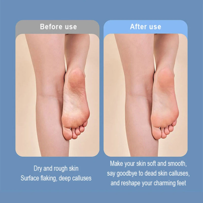 Rezultati pre i posle upotrebe elektricne turpije dubinsko skidanje mrtve koze glatke pete bez pukotina i kalusa