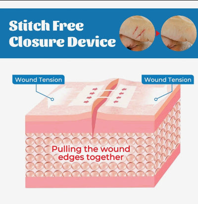 Dijagram mehanizma uredjaja za spajanje ivica rane bez savova za profesionalno zatvaranje i sigurno zarastanje