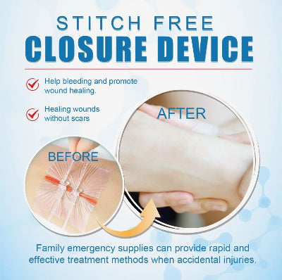 Prikaz efikasnog zatvaranja rane uredjajem bez savova, omogucava brzo lecenje i smanjuje pojavu oziljaka