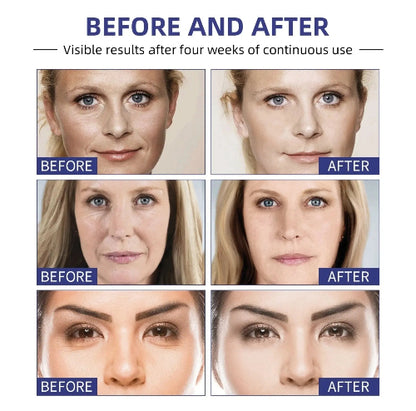 Detaljni pre i posle rezultati kreme protiv bora na razlicitim delovima lica. Smanjuje bore oko ociju, usana i na obrazima.