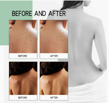 Sprej za akne na ledjima - Azijashop