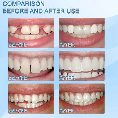 Vizuelni prikaz zuba pre i posle upotrebe SmileFitPro mase za zube pokazujuci poboljsanje izgleda osmeha