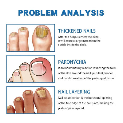 Analiza problema sa noktima: zadebljani nokti, paronihija i lomljivi nokti. Gel za regeneraciju i lečenje oštećenih noktiju.