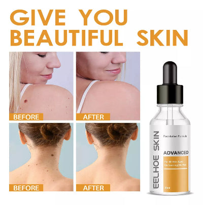Eelhoe skin advanced serum za uklanjanje koznih izraslina, bradavica i mladeza. Prirodni sastojci, sigurno i efikasno.