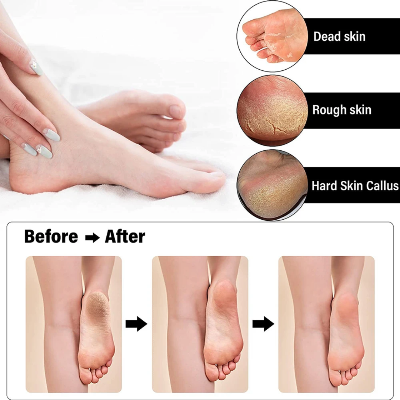 Elektricna turpija za pete vidljivi rezultati pre i posle tretmana uklanjanje zadebljanja mrtve koze i pukotina na petama