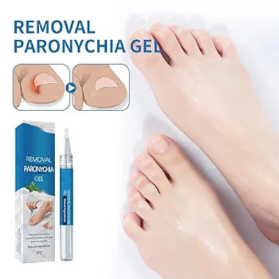 Efikasan gel za uklanjanje gljivica na noktima i paronihije. Prikaz kako se proizvod koristi za tretiranje noktiju na nogama.