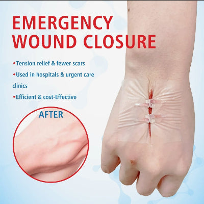 Hitno zatvaranje rane bez potrebe za hirurskim savovima sa uredjajem za zatezanje za cisto i efikasno lecenje