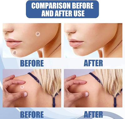 Uporedni prikaz pre i posle koriscenja flastera. Jasno smanjenje i uklanjanje mladeza i bradavica na vratu i licu.