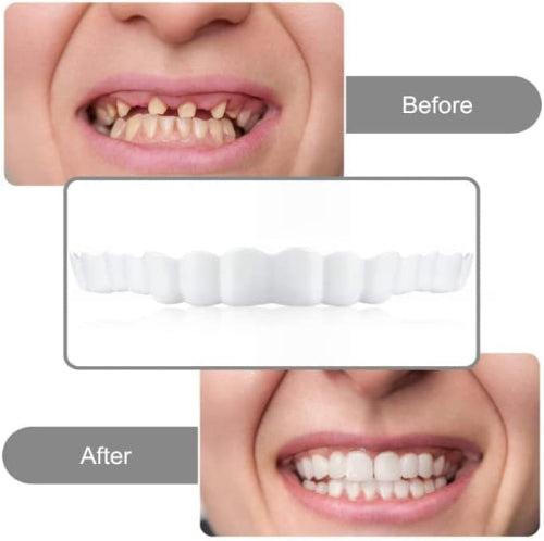Snap On Smile pre i posle: neverovatna transformacija osmeha. Brzo i jednostavno do savrsenih zuba. Idealno resenje za samopouzdan osmeh.