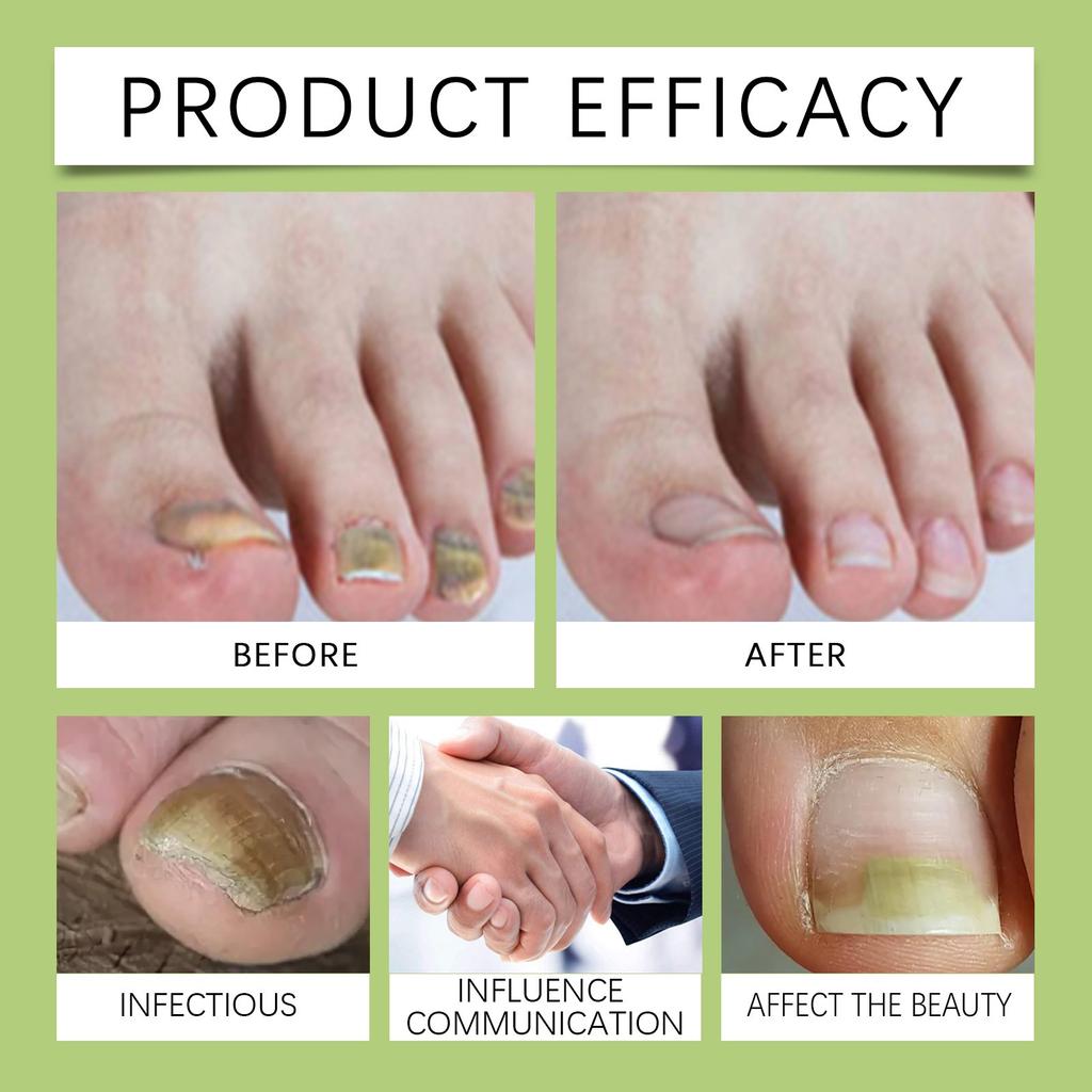 tecnost protiv gljivica na noktima pre i posle tretmana poboljsanje izgleda noktiju