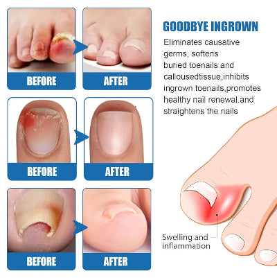 Tretman za urasle nokte na nogama i rukama. Slike pre i posle upotrebe koje pokazuju efikasno uklanjanje crvenila, upale i bola. Rešenje za zdravu regeneraciju noktiju.