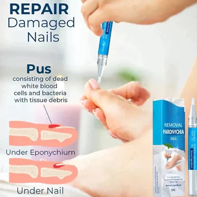 Tretman oštećenih noktiju. Prikaz procesa nanošenja gela za uklanjanje gnoja i poboljšanje stanja oštećenih i zaraženih noktiju.