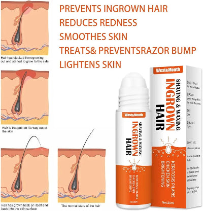 Detaljan prikaz urasle dlake u kozi i kako tretman deluje. Smanjuje crvenilo i sprecava upalu.