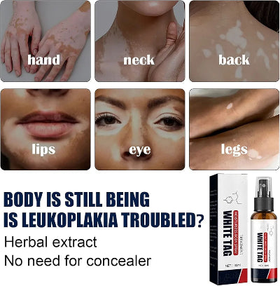 White Tag sprej za vitiligo na licu, vratu i telu. Efikasan tretman protiv belih mrlja i hiperpigmentacije kože.